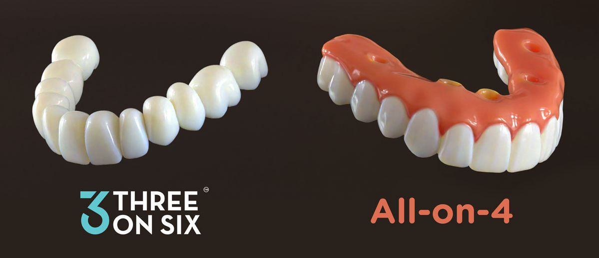 Side by side of 3 on 6 dental implants and All-on-4 dental implants