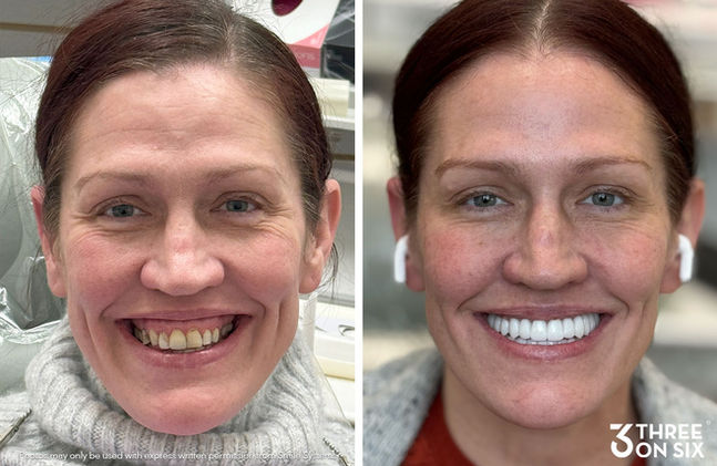 Before and after of 3 on 6 patient