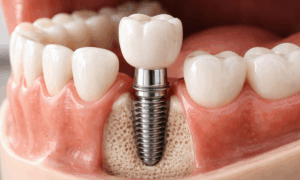 What are Dental Implants? And Why Dental Implants Are Safe?