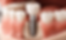 What are Dental Implants? And Why Dental Implants Are Safe?