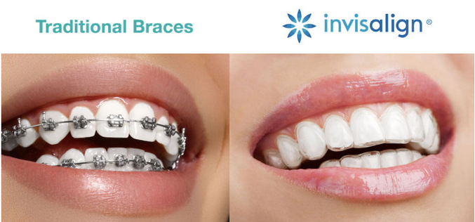 Invisalign invisible braces