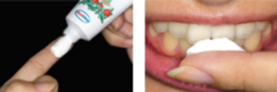 Tooth Mousse - Uses, Benefits, and Every Dental Problem It Can Help With