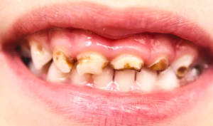 Tooth Mousse For Tooth Decay