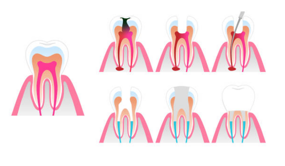 Root canal treatment