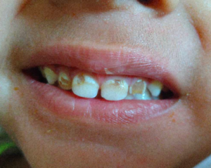 Uses of Tooth Mousse