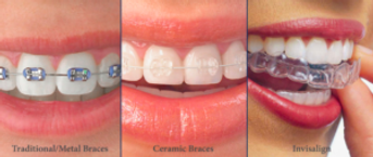 Step 7 - Orthodontic braces selectionā