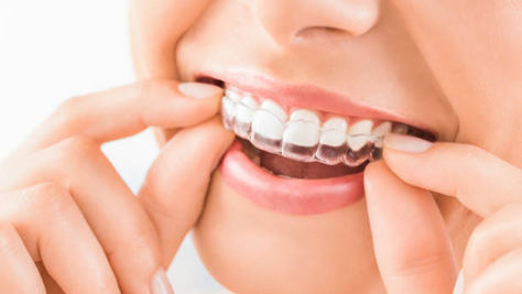 Complete Guide to Clear Aligners: How it Works, and Benefits