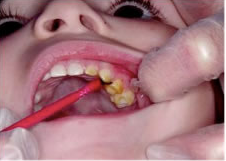How-is-pediatric-dental-treatment-beneficial-to-young-kids