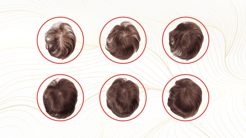 Hair transplant clinic in Hyderabad