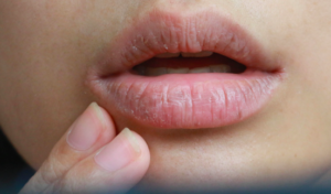 Tooth Mousse Helps With Dry Mouth
