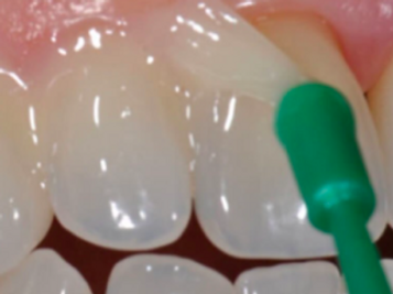 Role of Fluoride in Preventing Dental Caries in Kids