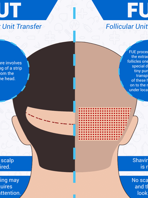 Best hair loss treatment for women in Hyderabad, hair specialist near Nacharam