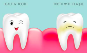 Dental plaque