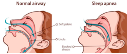 Sleep apnea might leads to mouth breathing