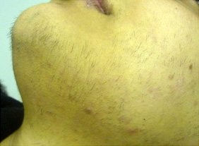 Hirsutism