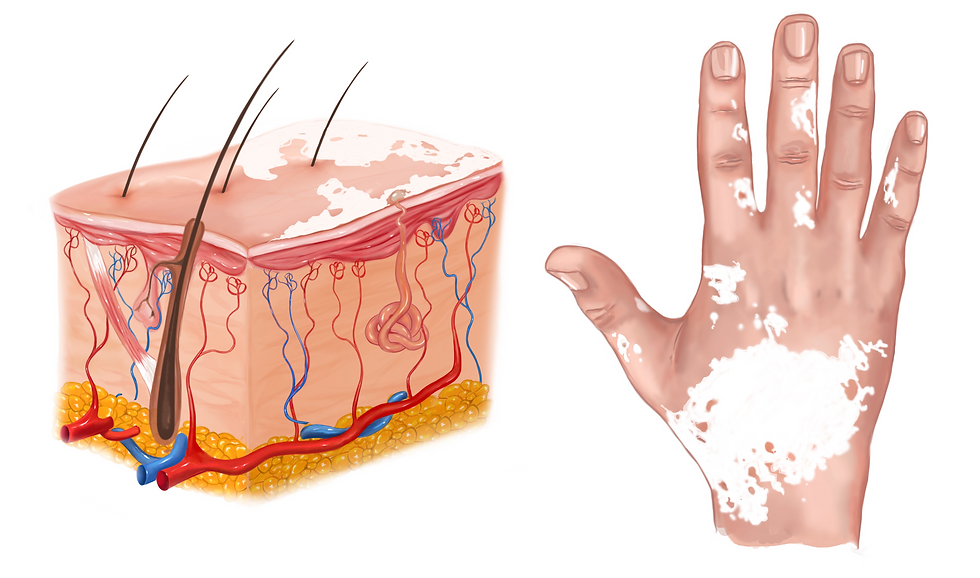 What is vitiligo and how it works. How many people are effected by vitiligo.