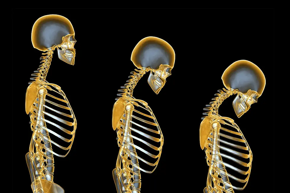 osteoporosis en adultos