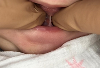 Tongue-tie type 2 before division