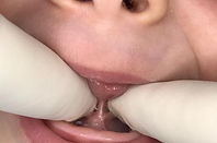 Tongue tie 2 before division