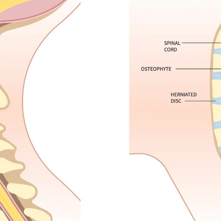 Understanding Degenerative Cervical Myelopathy