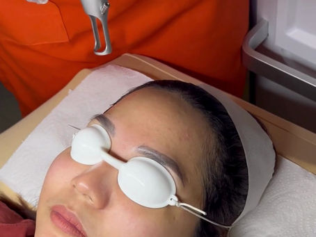 Discover the Benefits of Our Brightening Laser Facial