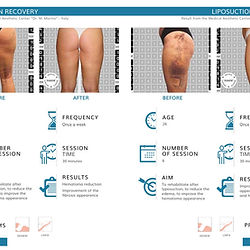 Before and after photos of legs, the text says: Lipo reduction from recovery.