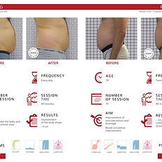 Remodeling Before and After images with visible text, massage hautstraffung icoone cellulite glattbrugg.