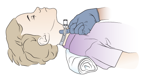 Tracheostomy Care.webp