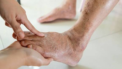 Diabetic foot