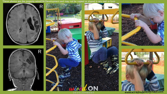 Constraint Induced Movement Therapy wiredON Development PT