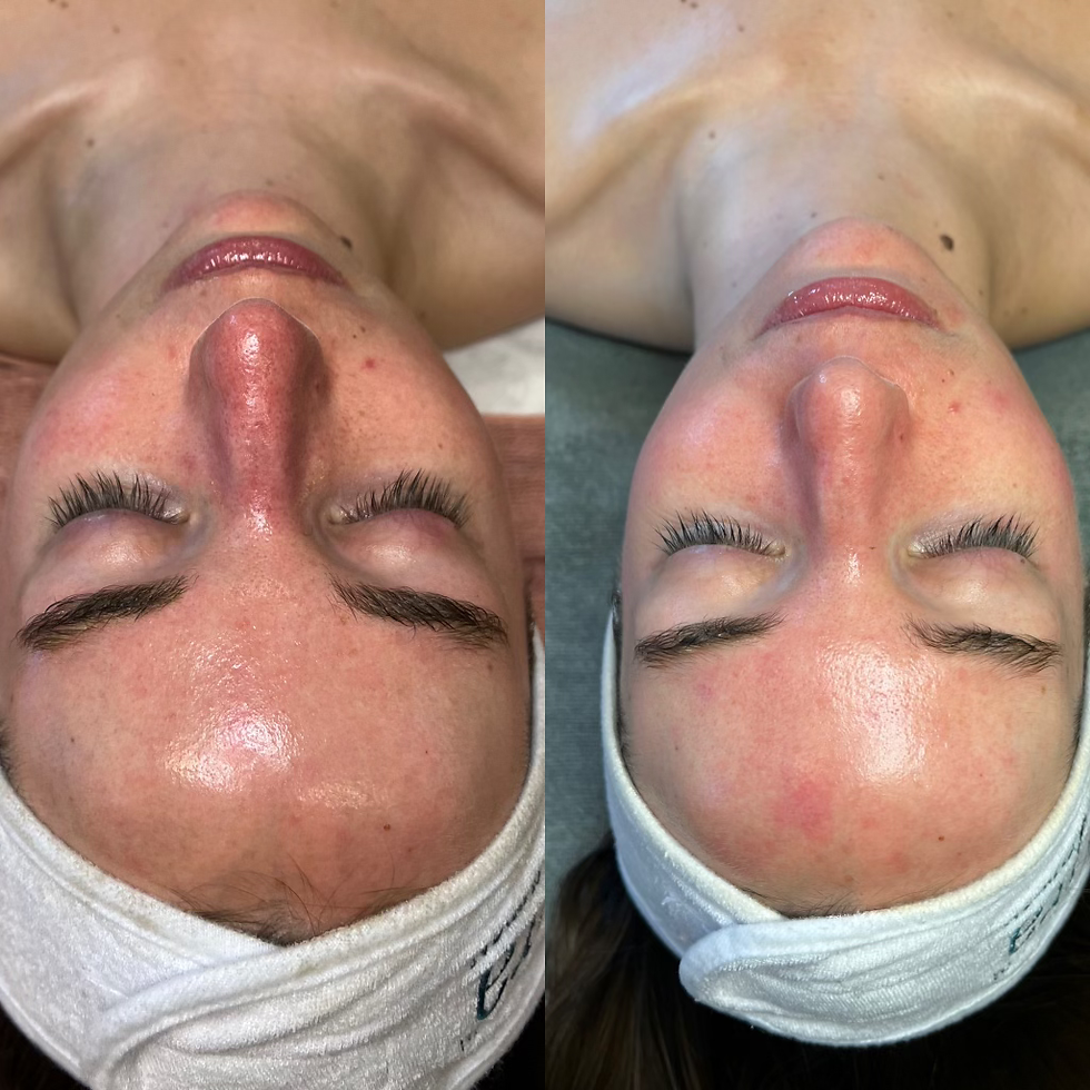 rosacea treatment before and after