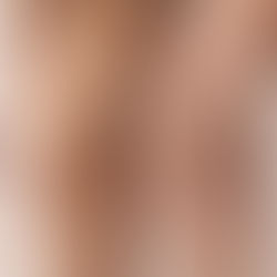 Ritenzione idrica: cos’è davvero e come la maderoterapia può aiutare