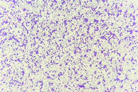 Leucemia Linfocítica Crônica