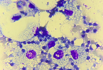 A paniculite nodular piogranulomatosa estéril (PNPE)