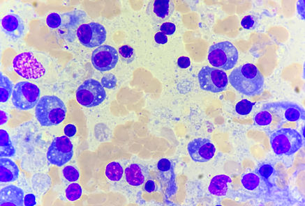Hiperplasia linfoide reativa