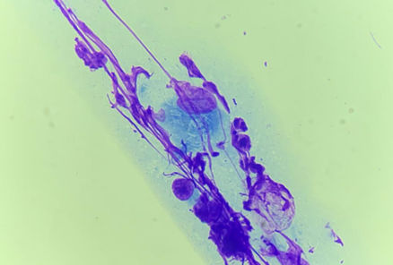 Mycobacterium