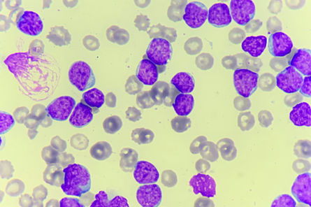 Leucemia Linfocítica Crônica