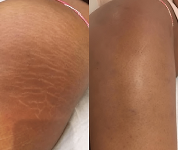 La Fontaine strech marks .png