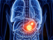 Բժիշկը թվարկել է ստամոքսի քաղցկեղի ախտանիշները