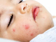 Կոկսակի վիրուս. ախտանիշներ երեխաների, մեծահասակների մոտ, ինչպես բուժել