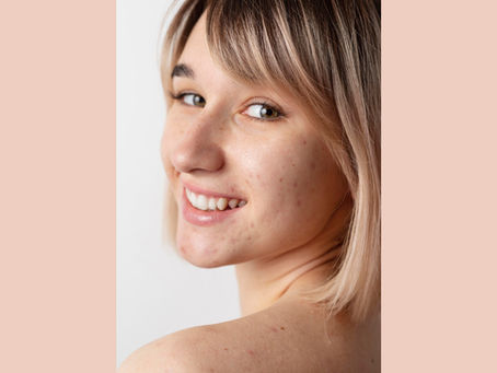 Understanding teen acne — what it is and isn’t