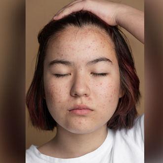 Support, not scrub: smarter acne care