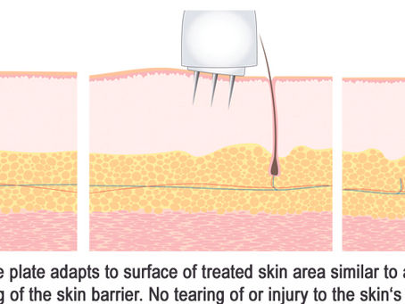 Medical Microneedling