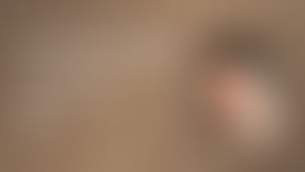 Choosing the Best Dermal Filler CLinic in Kokapet