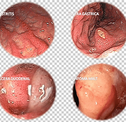 GASTRITIS WIX2.png