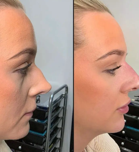Non Surgical Rhinoplasty.png