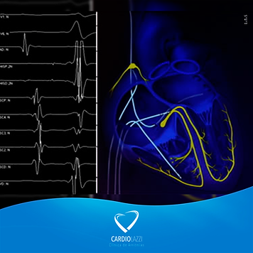 Cardiolazzi arrimitia