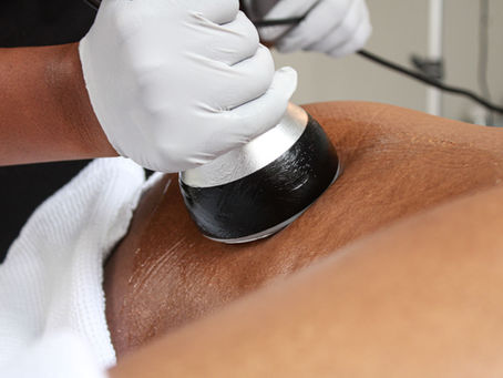 Before and after results of non-invasive body contouring in McKinney at Aesthetic Harmony