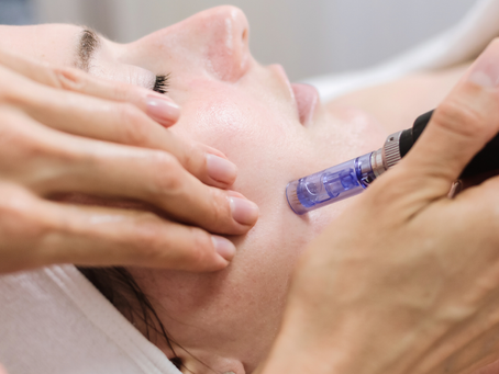 Woman receiving microneedling treatment with Candela Exceed device at Aesthetic Harmony Med Spa McKinney TX.