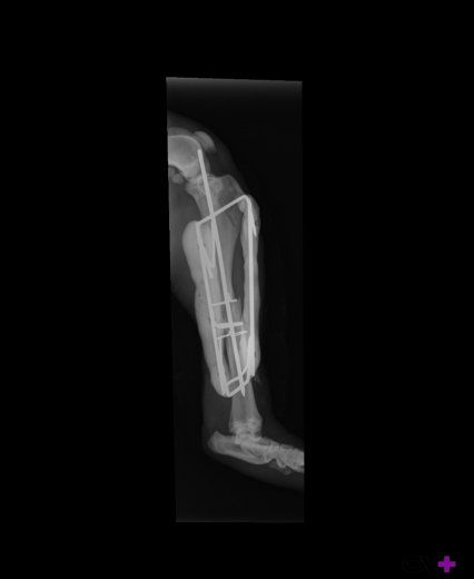 Miniatura: Alambre maleable para cirugia osea